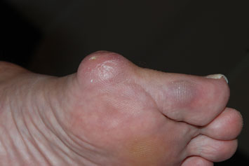 bunion on the big toe (red bump)