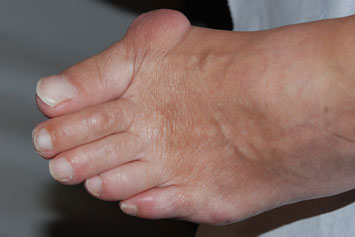 bunion on the big toe (red bump)