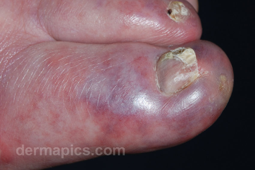 chilblains of the
                      toes