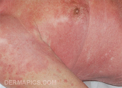 red rash skin: drug
                      eruption