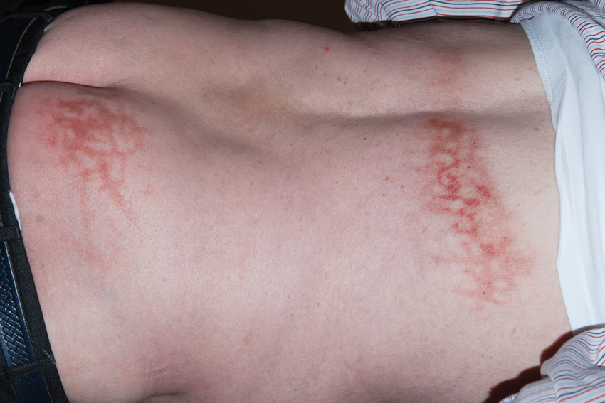 erythema ab igne on the back