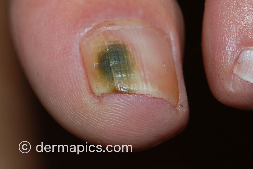 Fungal Nail Infections onychomycosis Pictures In High Resolution 