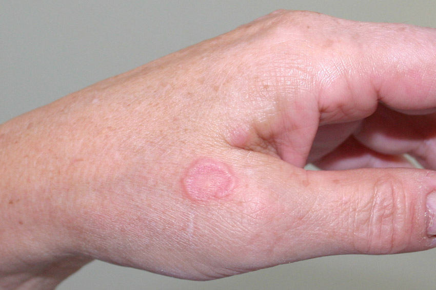 granuloma annulare on the hand