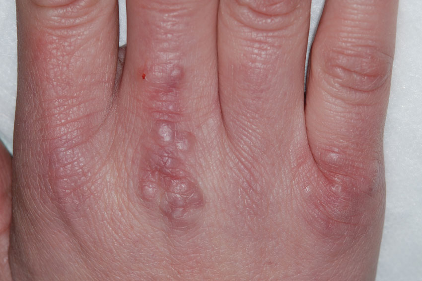 granuloma annulare looking like warts on the hand