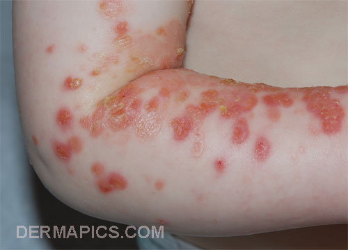 red spots and skin rash:
                      impetigo