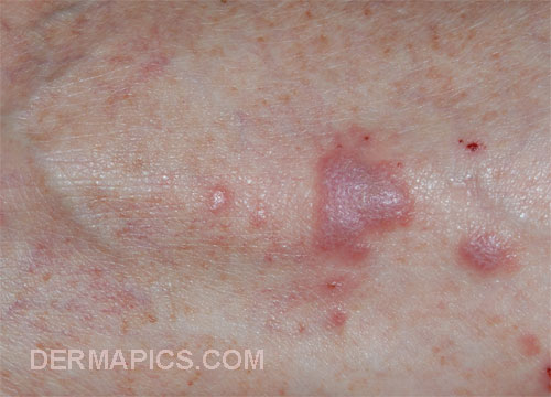 red spots and skin rash :
                      lichen ruber planus