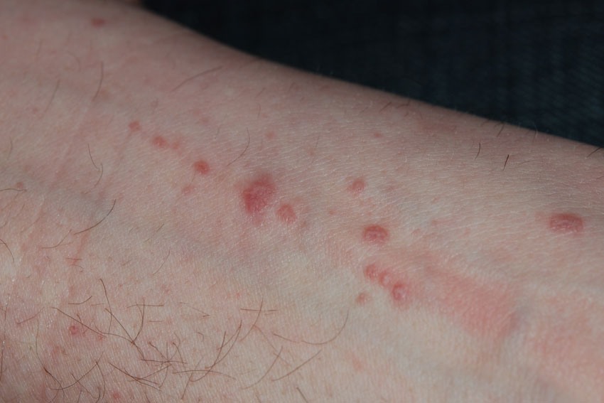 lichen planus on the
                      wrist