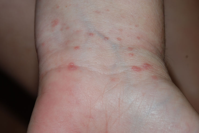 lichen planus on the
                      wrist