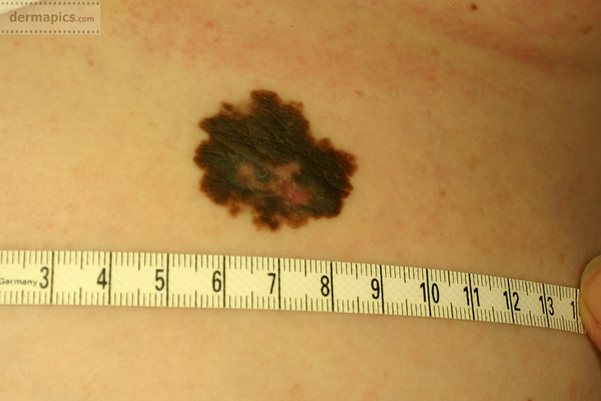 superficial spreading melanoma