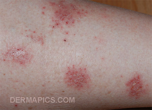 red skin rash: nummular
                      eczema