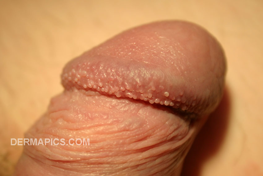 pearly penile papules