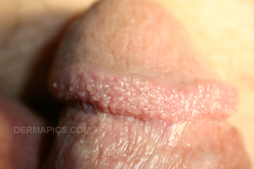 Picture of Warts - WebMD