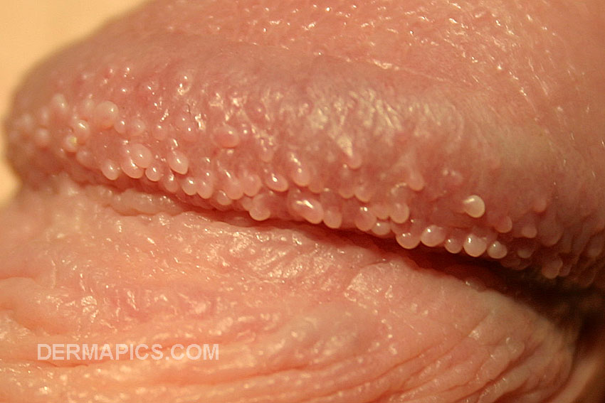 pearly
                      penile papules detail