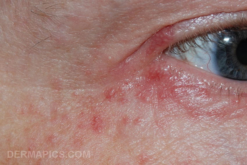 Periocular Dermatitis Pictures Photos 