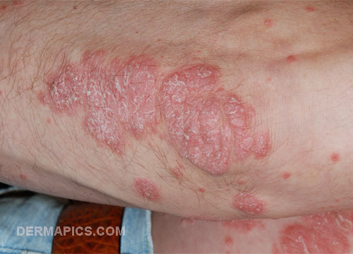 red spots
                      and rash: psoriasis