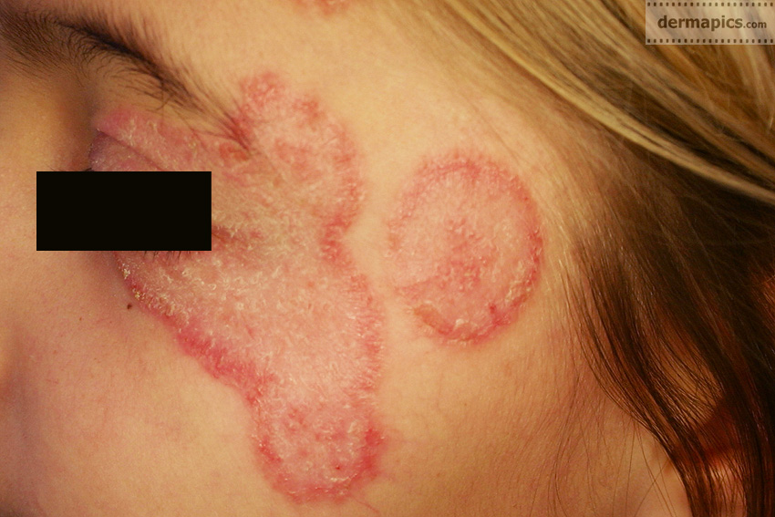 Fungal Infection Of The Skin ringworm Pictures And Clinical Information