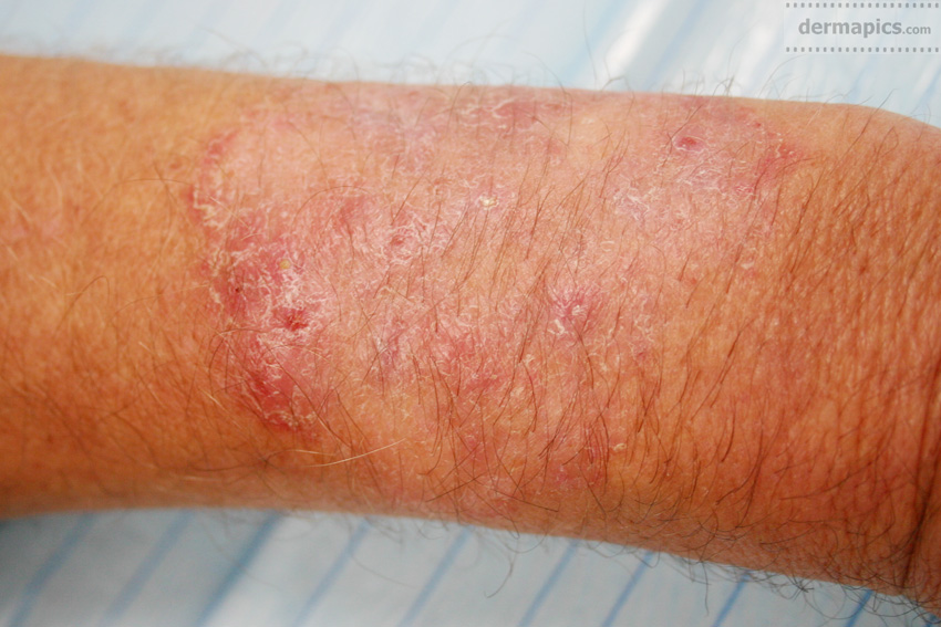 Can A Fungal Skin Infection Make You Feel Ill