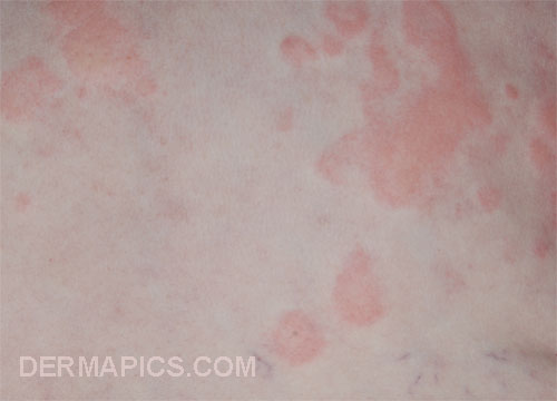 red spots
                      and rash: how to compare: urticaria