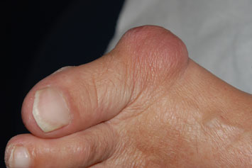 bunion on the big toe (red bump)