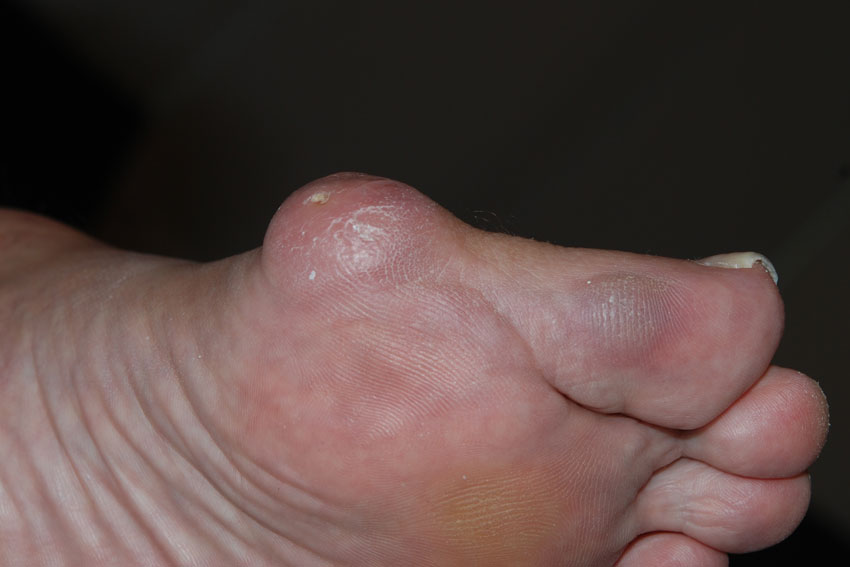 bunion on the big toe