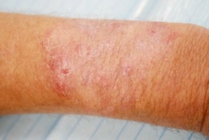 superficial fungal infection (ringworm)