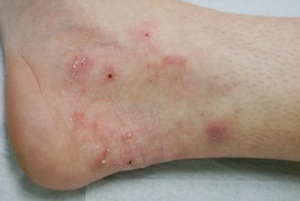 superficial fungal infection (ringworm)