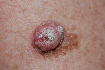 Keratoacanthoma arising in naevus