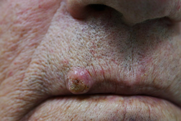 Keratoacanthoma on the lip