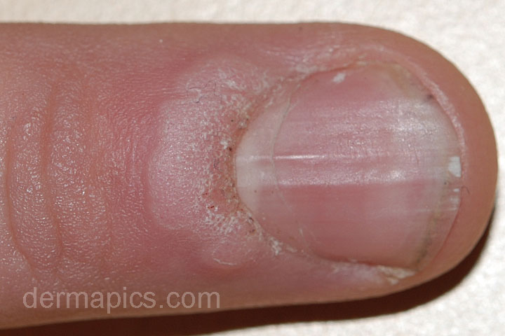 wart at the nail
                        fold