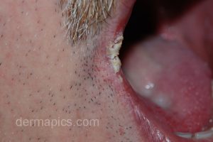 candida mouth angular cheilitis