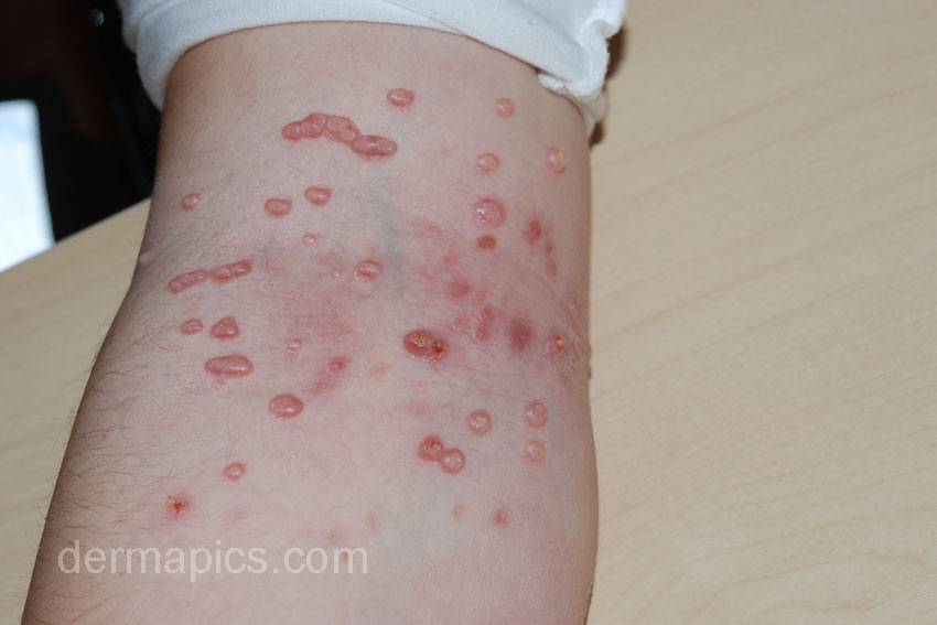 molluscum contagiosum atopic dermatitis eczema