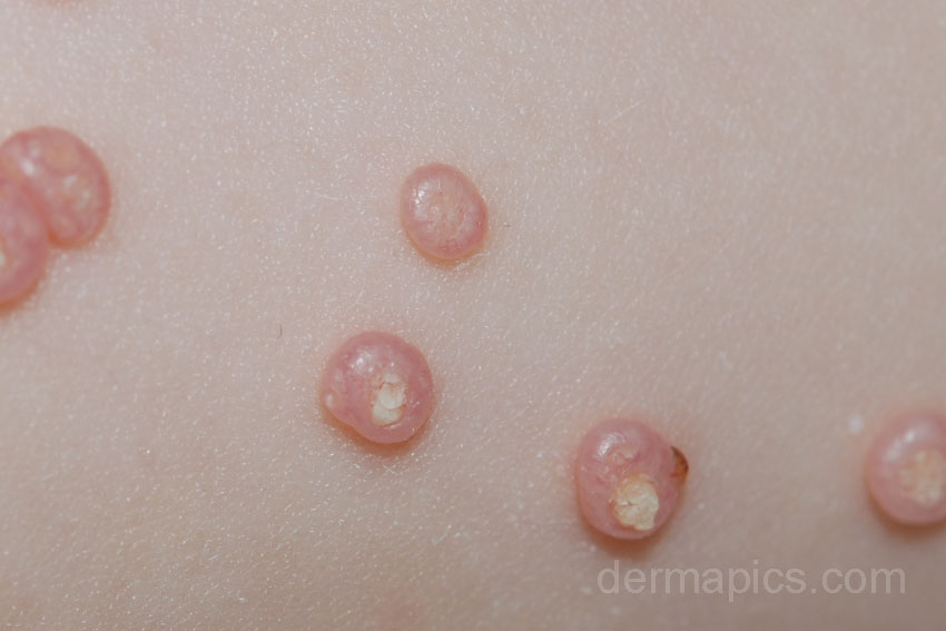 molluscum contagiosum white dome