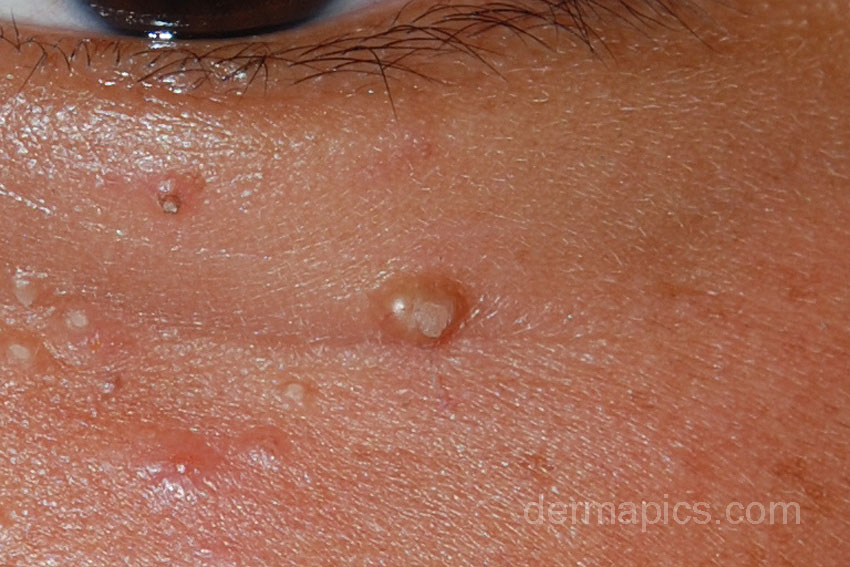 molluscum contagiosum face